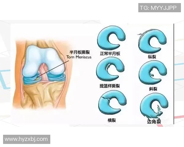 半月板损伤后的足球球员能否继续踢球及其恢复过程解析 半月板损伤后的足球球员能否继续踢球及其恢复过程解析